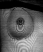 Moire fringe patterns projected onto a breast