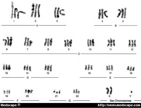 Karyotype of 69,XXY (triploidy), common finding in spontaneous abortion. Risk for chromosomal anomaly in subsequent pregnancy is not increased significantly.